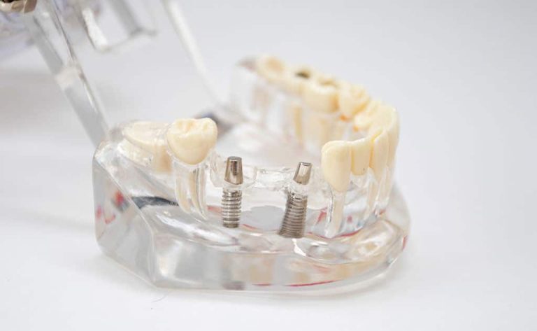 Implantes Imediatos – a evolução da Carga Imediata