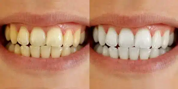 Dentes amarelos e tabaco