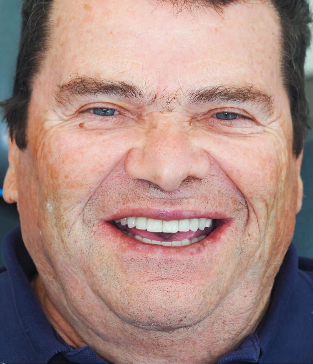 Facetas dentárias antes e depois clínica dentária em oeiras