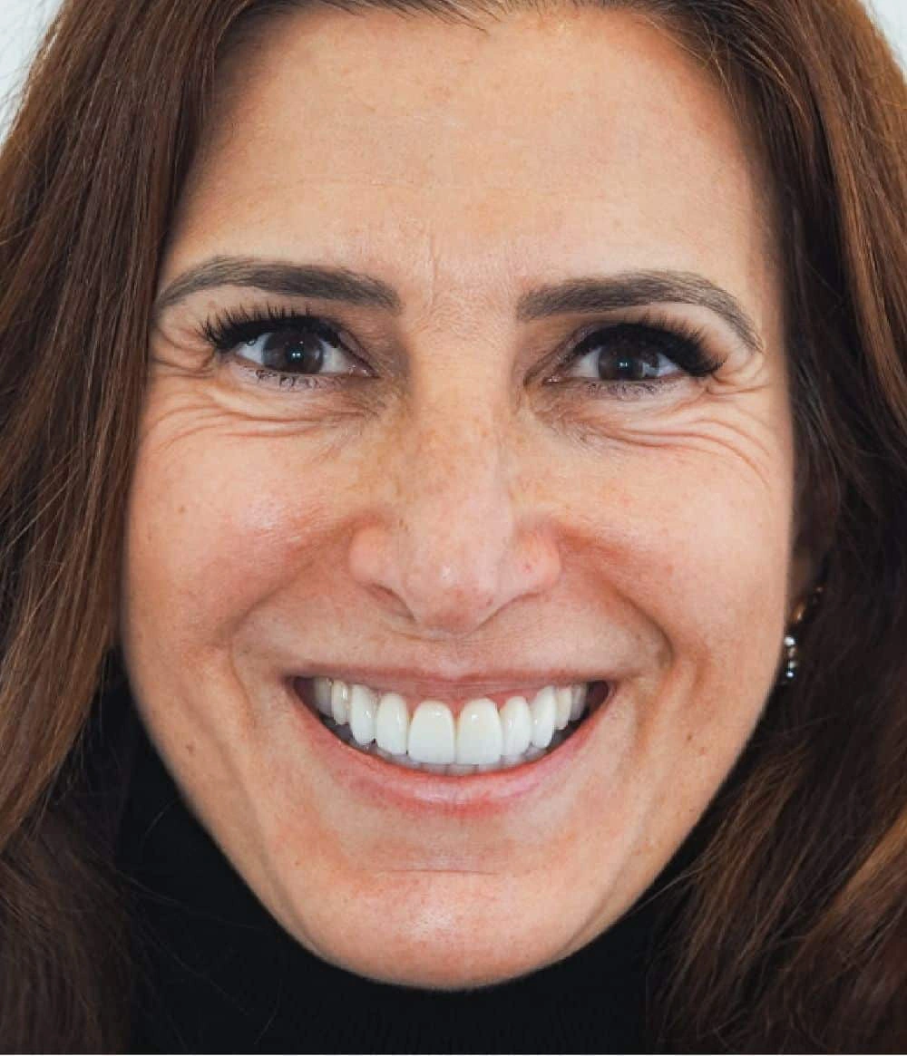 Lentes dentárias resultado natural sorriso