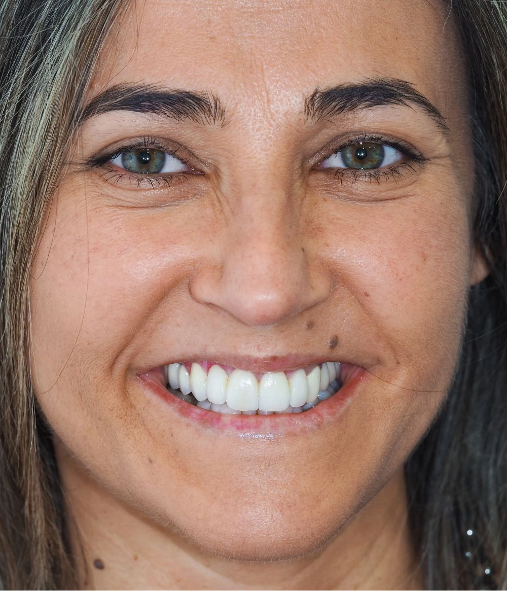 Resultado de branqueamento dentário profissional em oeiras