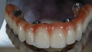 mostra do implnte dentario na Clínica Dr.PedroCoelho