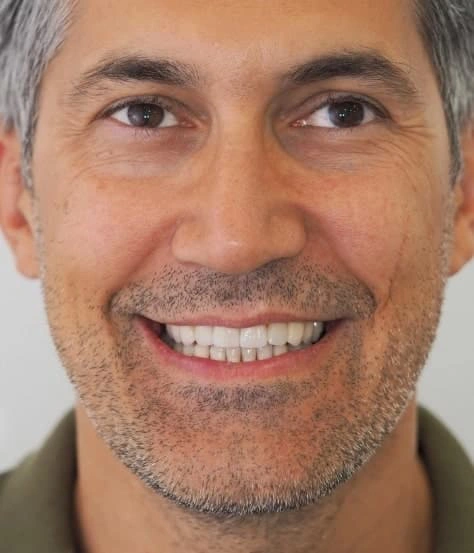 Sorriso reabilitado com implantes dentários em Portugal