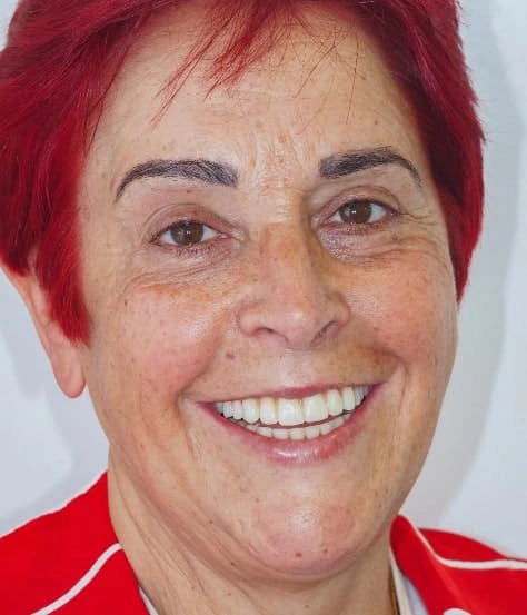 Resultado real de implantologia oral na Clínica Dr. Pedro Coelho