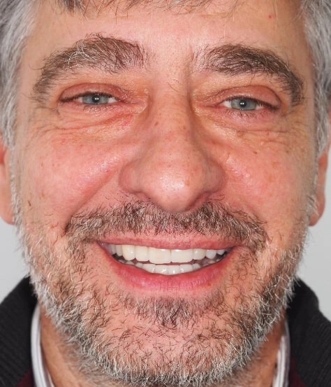 Paciente após reabilitação com implantes dentários em Oeiras