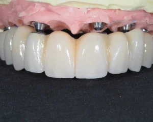 implante dental, O que é a reabilitação oral?