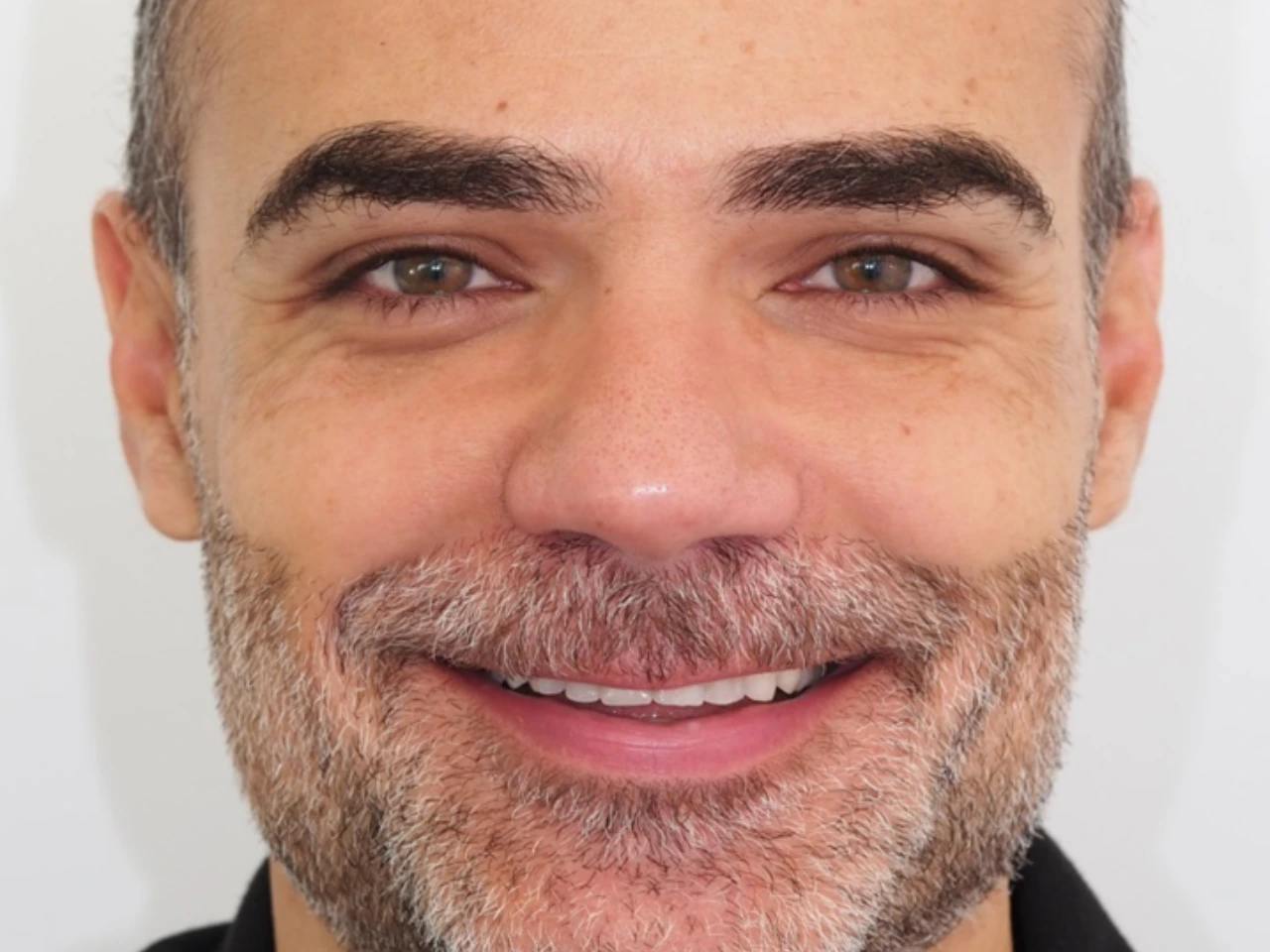 Sorriso antes do tratamento com facetas na Clínica Dr Pedro Coelho em Oeiras