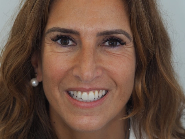 Estado inicial antes das facetas