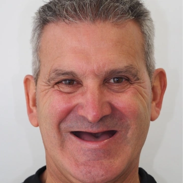 Estado inicial antes dos implantes