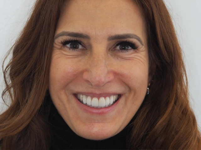 Resultado final de facetas dentárias