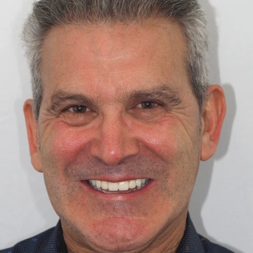 Resultado final de implantes dentários