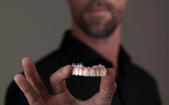 Implantes dentários para substituir vários dentes